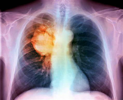 si-arricchisce-l’offerta-di-servizi-per-i-malati-di-cancro-al-polmone